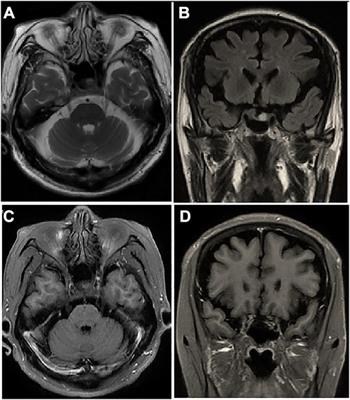 Case report: 18F-FDG PET confirmed pupil-sparing third nerve palsy heralding aseptic cavernous sinus embolism in patient with chest malignancy